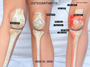 Biến chứng nguy hiểm của thoái hóa khớp gây đau nhức, biến dạng và tàn phế.