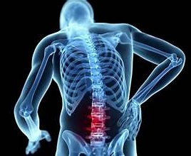 Thoái hóa cột sống thắt lưng: Nguyên nhân, triệu chứng và cách điều trị hiệu quả